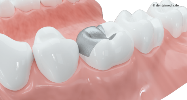 Laborgefertigte Fuellung Amalgan Laborgefertigte Fuellung Amalgan