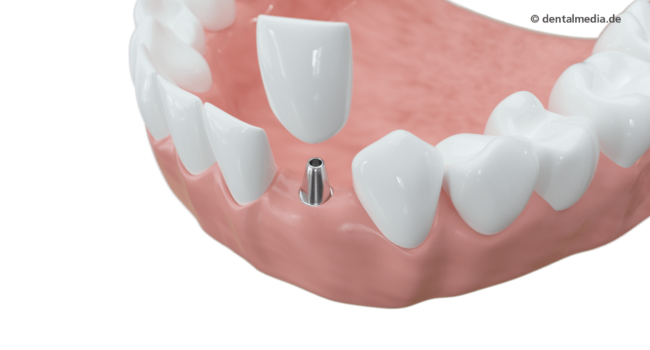 Ein Zahn fehlt: Ein Implantat hat gegenüber einer Brücke den Vorteil, dass Nachbarzähne nicht geschliffen werden müssen.