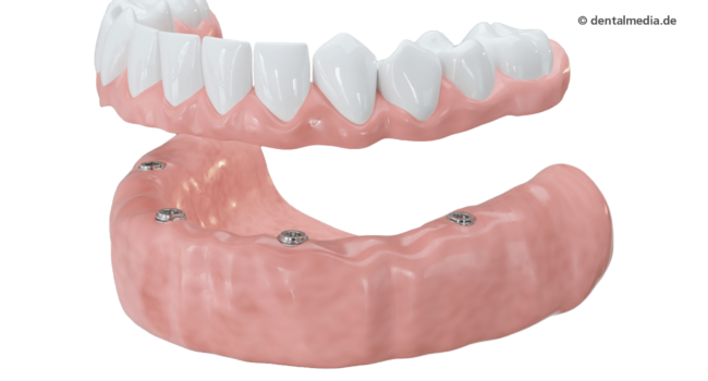 prothese Ein Großteil der Zähne oder alle Zähne fehlen. Mit mehreren Implantaten haben Teil- oder Vollprothesen, herausnehmbar oder festsitzend, einen festen Halt.