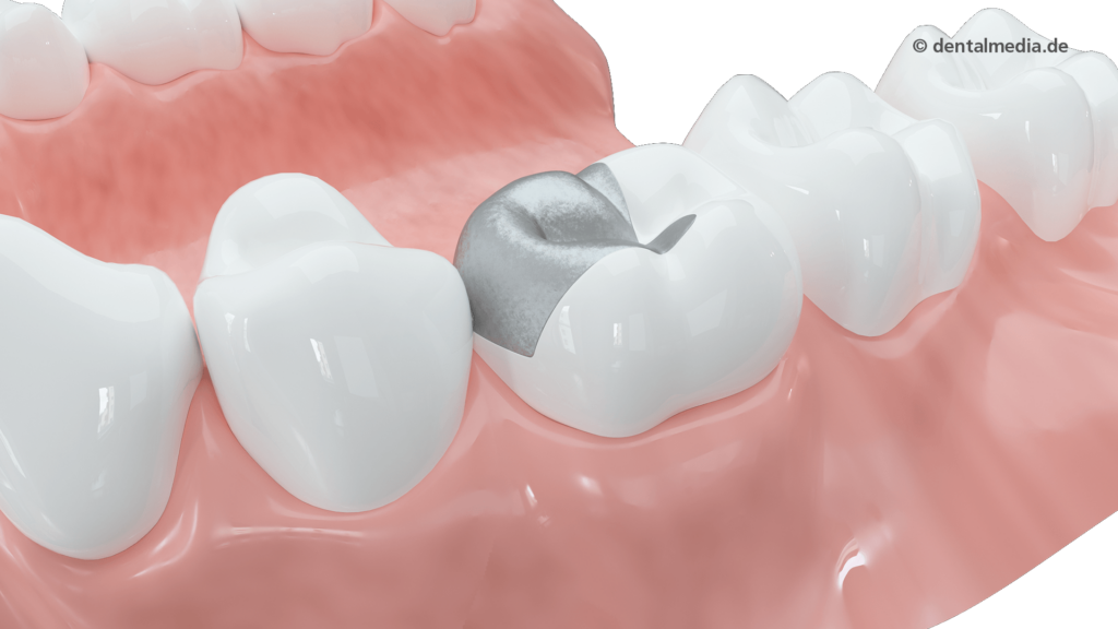 Amalgam-Füllung